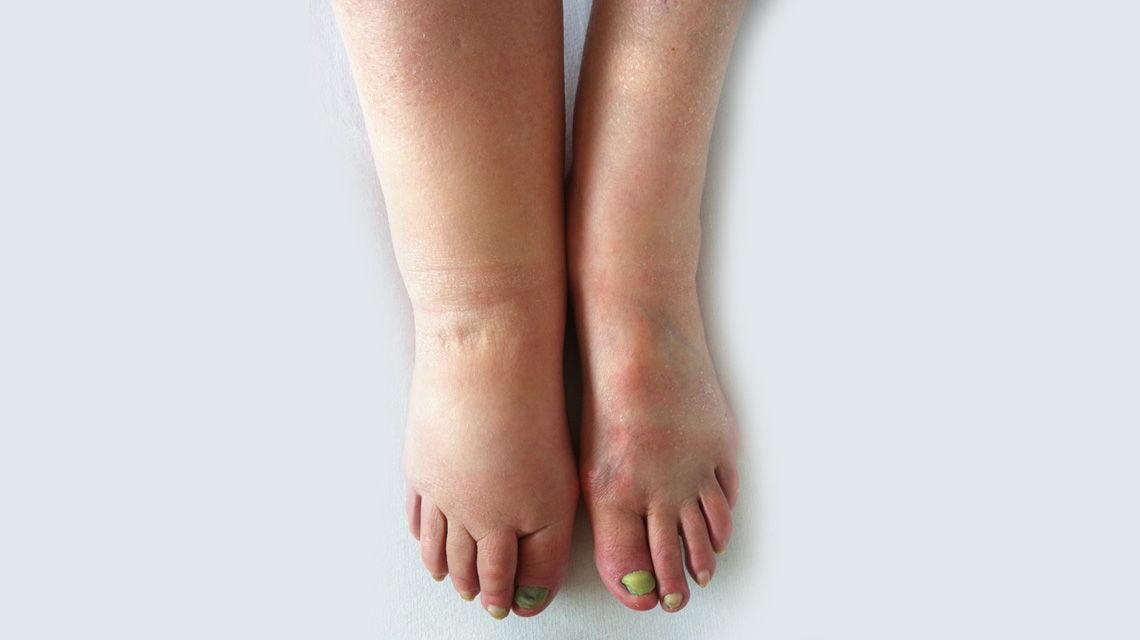 Lymphedema Management