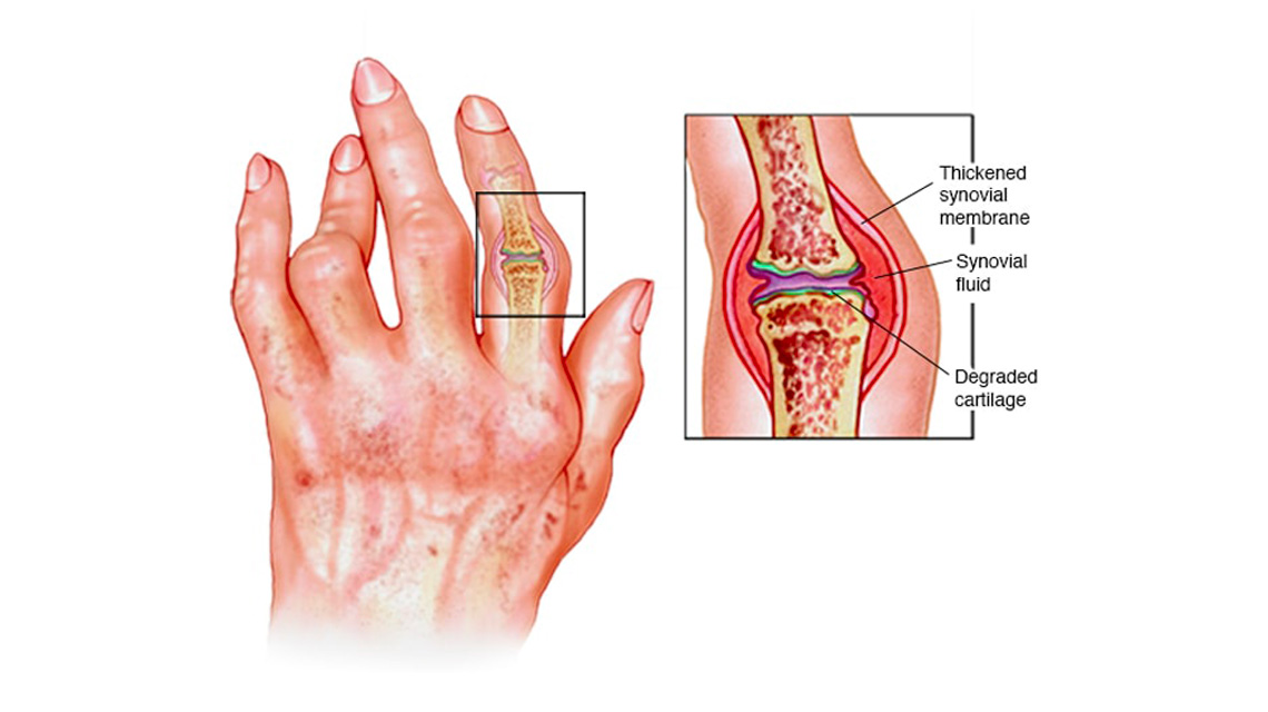 Rheumatoid Arthritis